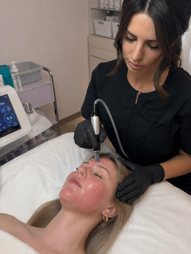 Microneedling-001